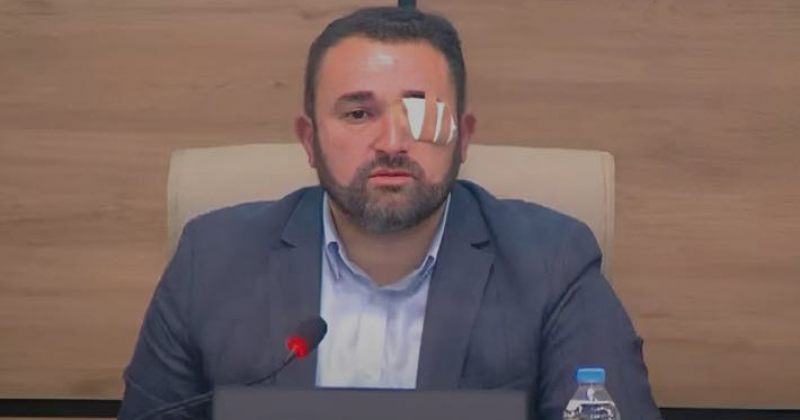 კალანდარიშვილი: გარკვეული წვის შეგრძნებები მაქვს თვალის არეში, თუმცა რქოვანა არ დაზიანებულა