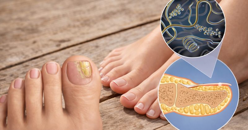 როგორ ვუმკურნალოთ სწორად ფრჩხილის სოკოს და რა რეკომენდაციები უნდა გავითვალისწინოთ (რ)